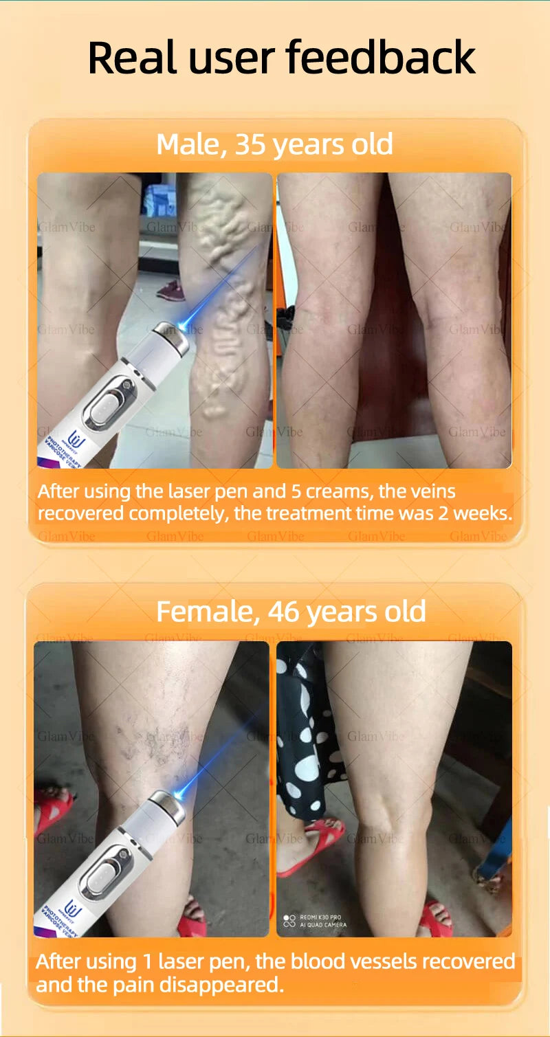 Laser venous pointers address varicose veins, and leg care tools are hot sellers.