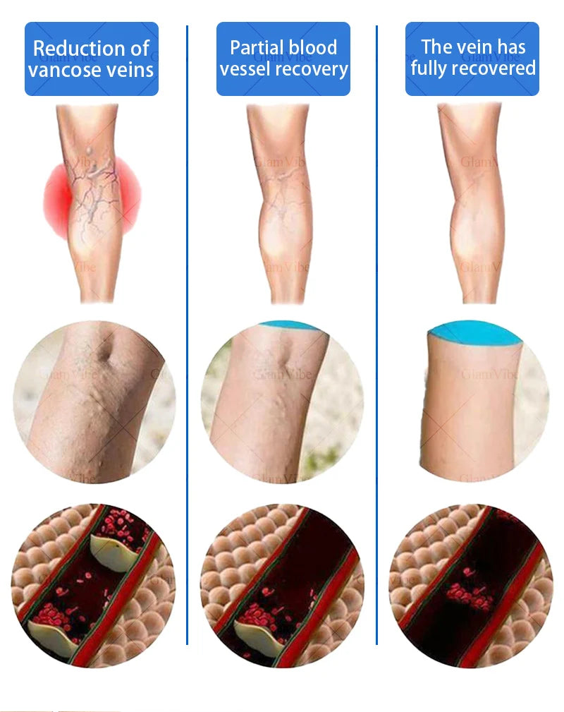 Laser venous pointers address varicose veins, and leg care tools are hot sellers.