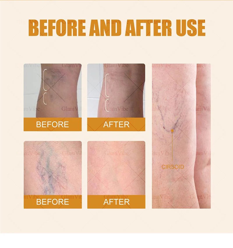 Laser venous pointers address varicose veins, and leg care tools are hot sellers.